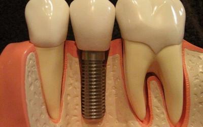 Anatomy of Dental Implants: How They Work