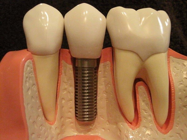 Dental Implant Surgery Side Effects
